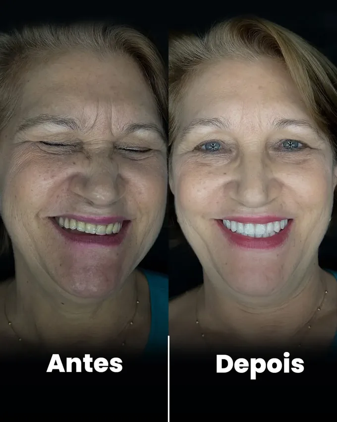Antes e depois de paciente atendida pela Dra. Amanda Marangon em Cuiabá