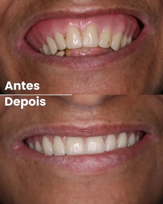 Antes e depois de reabilitação do sorriso em Cuiabá