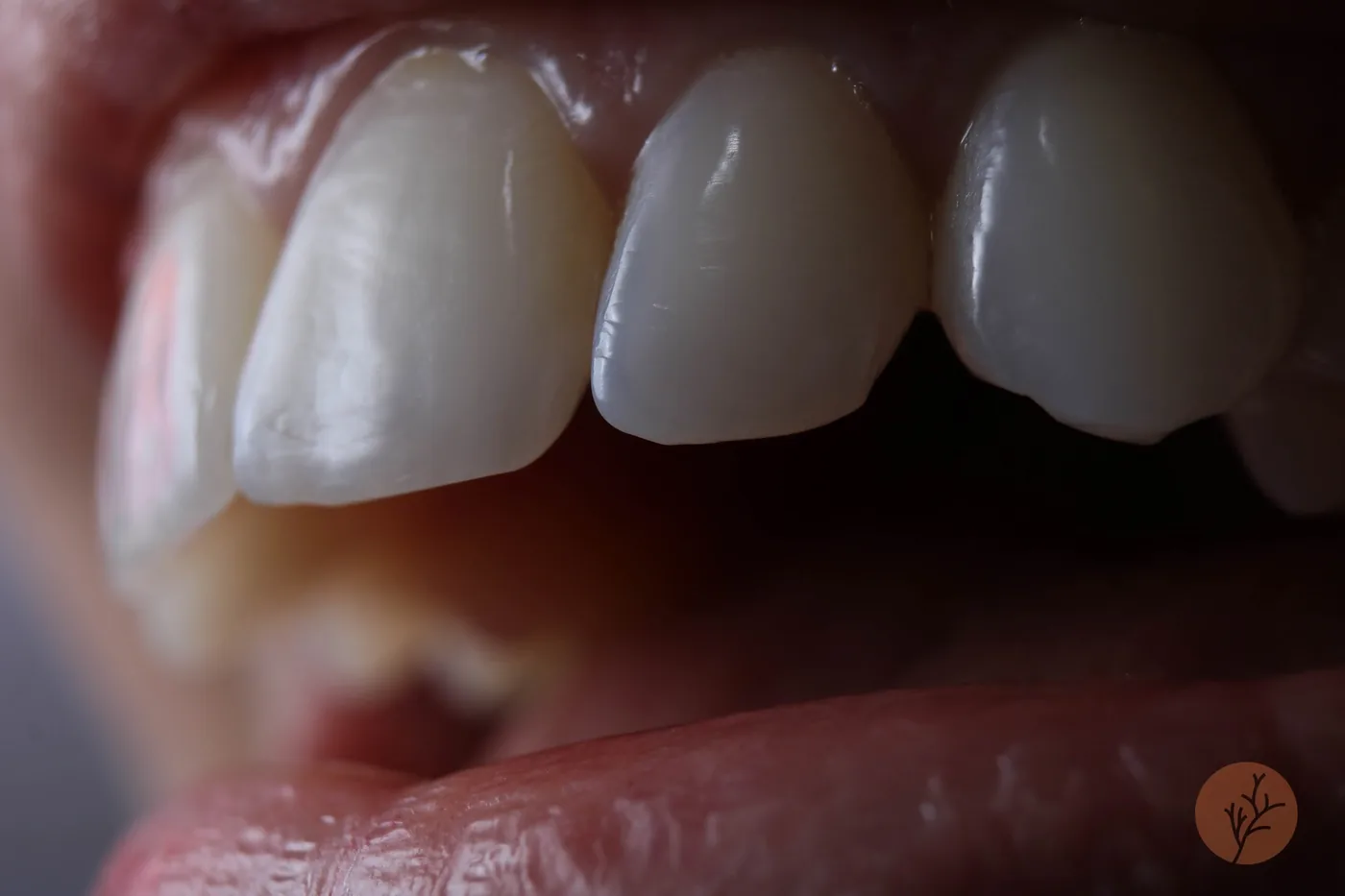 Close do resultado de um implante dentário realizado pela Dra. Amanda Marangon