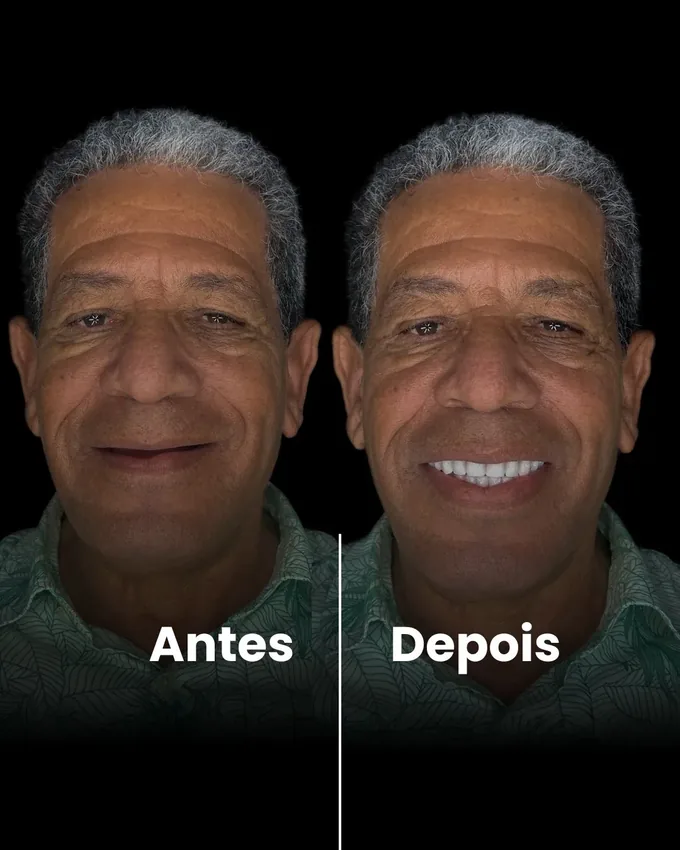 Implantes dentários realizados em Cuiabá