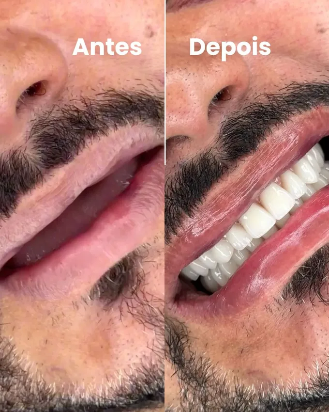 Próteses dentárias modernas feitas em Cuiabá